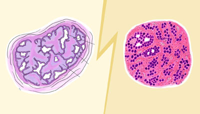 PHYLLODES TUMOR VS. DUCTAL CARCINOMA