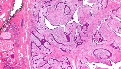 PHYLLODES TUMORS EXPLAINED