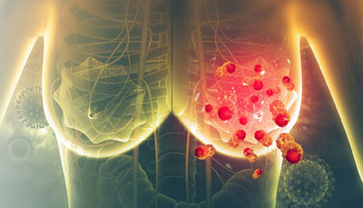 POSTMENOPAUSAL BREAST CANCER
