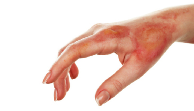 Managing Radiation Burns on the Skin