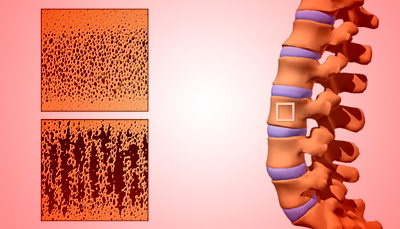 Managing Bone Density Loss after Long Term Hormone Therapy