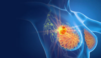 MRI VS MAMMOGRAM FOR WOMEN WITH DENSE BREASTS