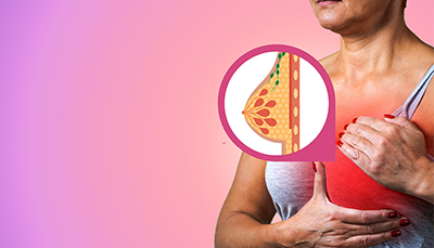 INFLAMMATORY BREAST CANCER