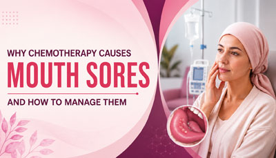Why Chemotherapy Causes Mouth Sores and How to Manage Them