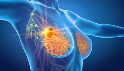 Is PET CT Required for All Patients Suffering from Breast Cancer?