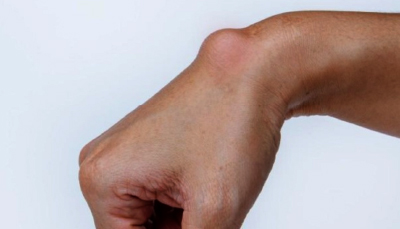 A LUMP THAT APPEARS AND DISAPPEARS