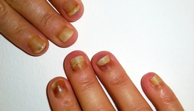 NAIL CHANGES DURING CHEMOTHERAPY