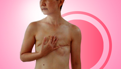 What to Know Before Deciding on a Prophylactic Mastectomy